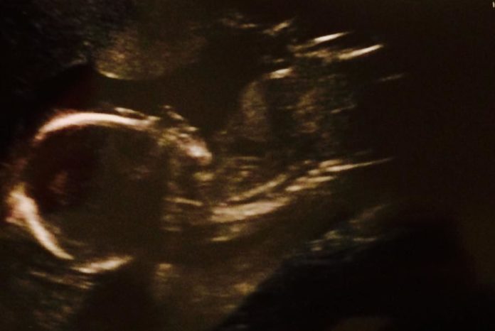 Ultrasound 20 weeks photo of baby ultrasound scan